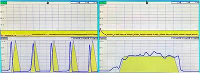 Pelvic floor dysfunction and electrophysiology in postpartum women at 6–8 weeks